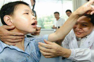 癫痫病高发人群有哪些
